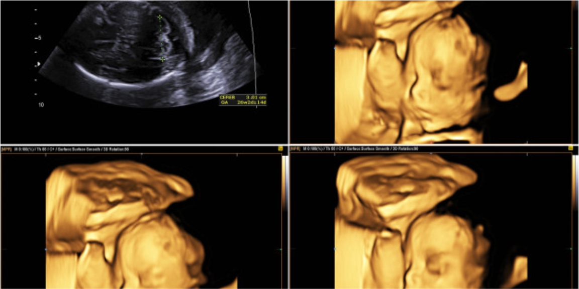 3D & 4D Ultrasound Available at CDC