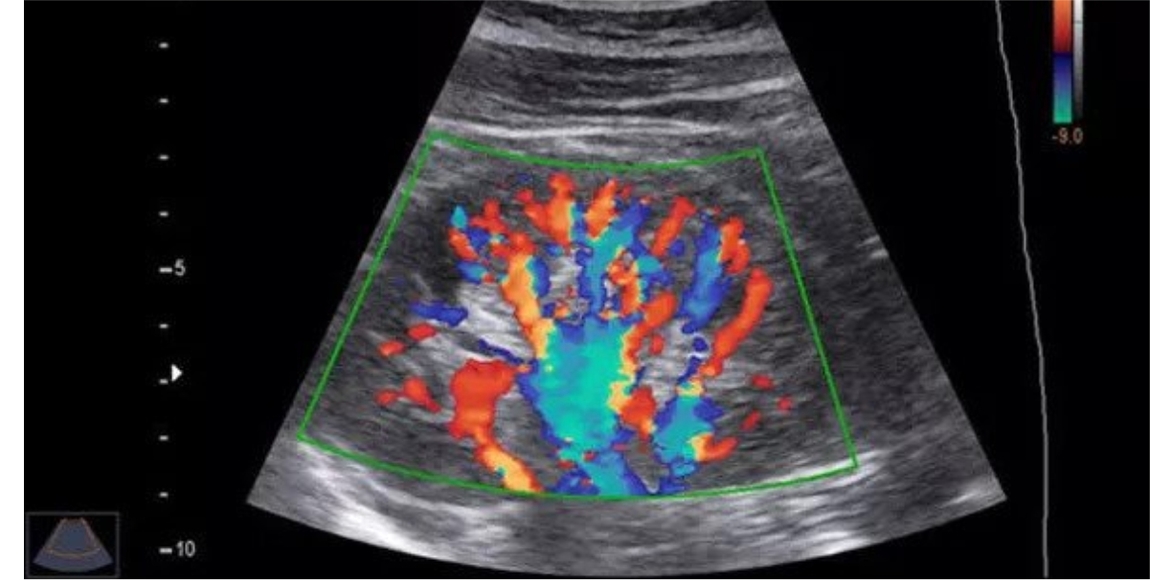 Color Doppler , Carotid Doppler, Available at CDC